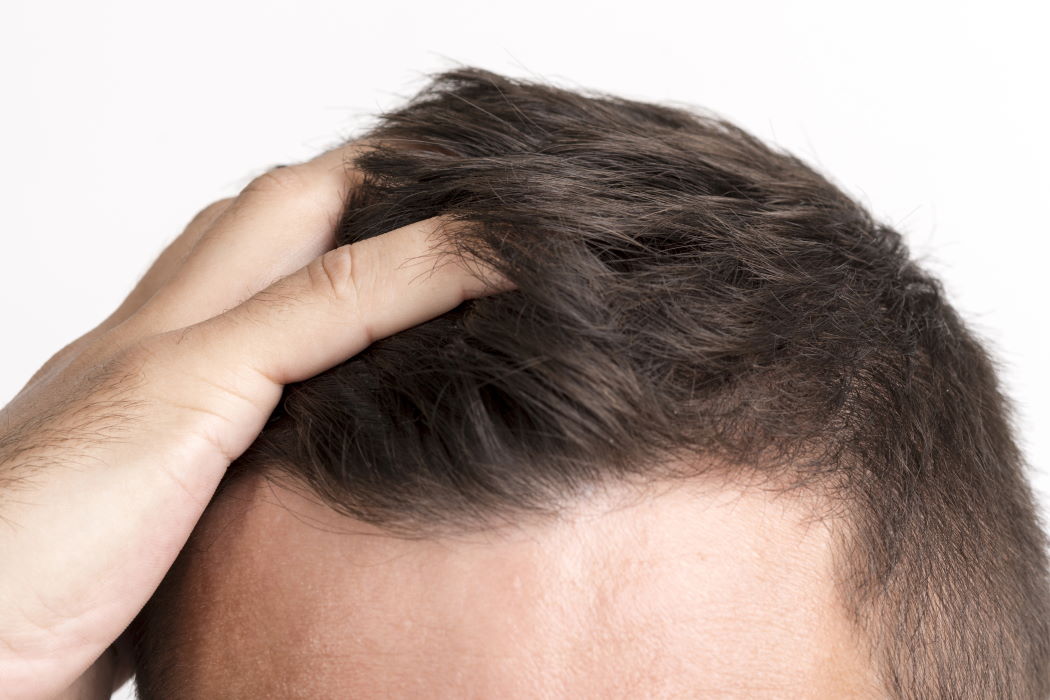 Пересадка волос и эффективность лечения